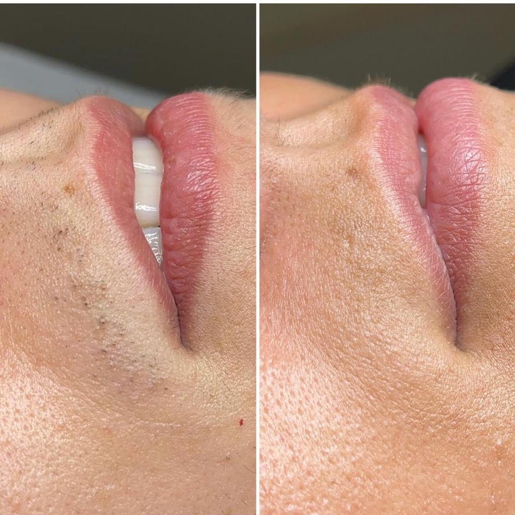 EpilStar — efekt zabiegu 3